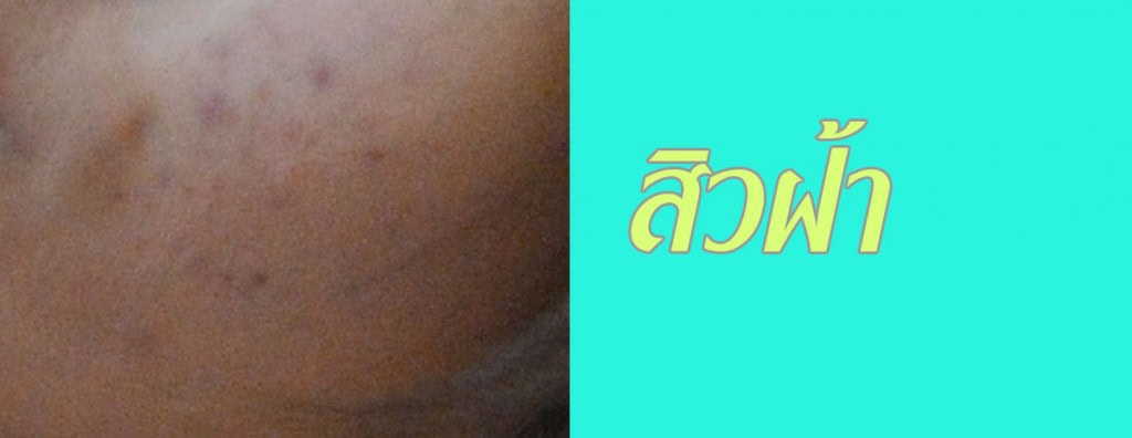 รักษาอาการ สิวฝ้า