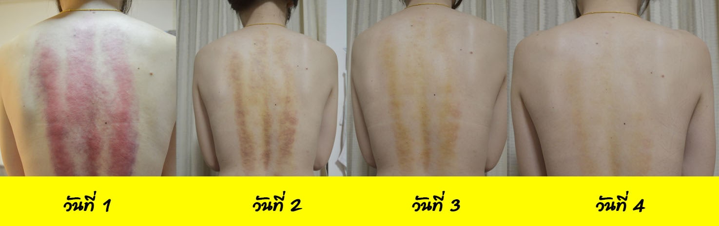รอยการขูดกัวซา