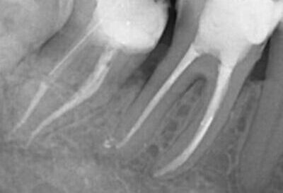 Tratament de canal sub microscop