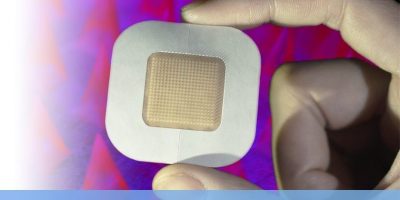 Researchers were able to preload enough insulin into the coin-sized adhesive microneedle patches to enable clinical use. [Image courtesy of UCLA]