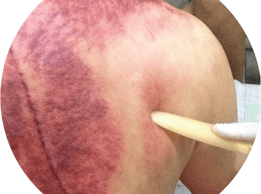 กัวซากับการขูดพิษ