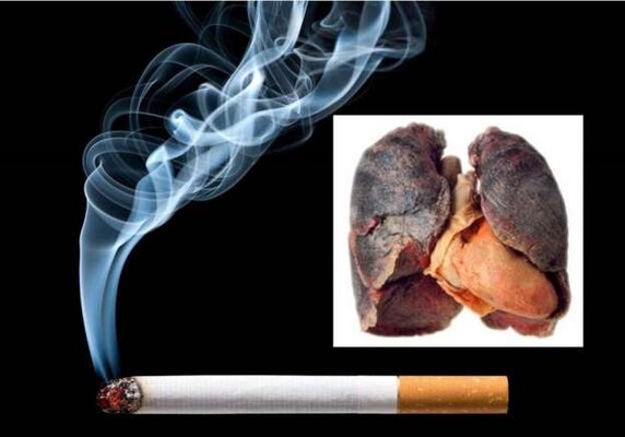 Ung thư phổi – căn bệnh xếp vị trí Á quân trong top các bệnh ung thư tại Việt Nam
