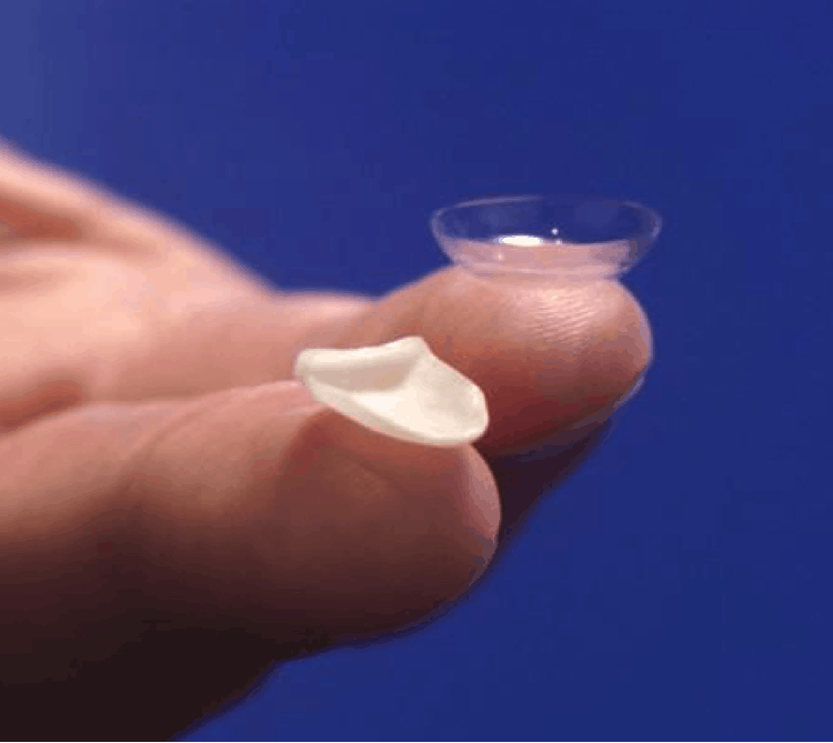 Dental Veneers