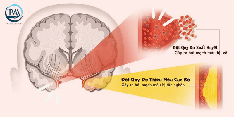Bệnh đột quỵ có được bảo hiểm không?