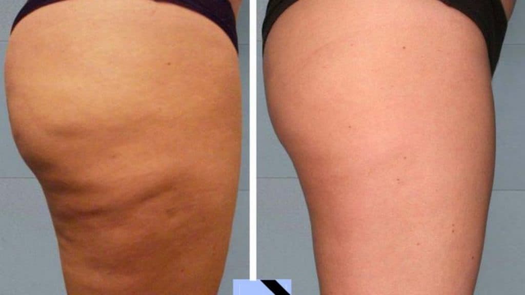 Celulitis como eliminarla Celulitis como eliminarla