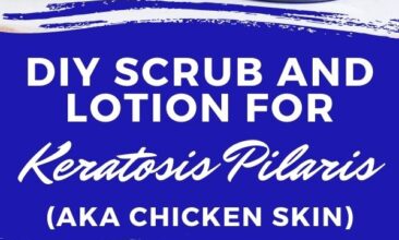 Pinterest pin with two images. One image is of two jars of lotion sitting on a table outdoors. The second image is of an open jar filled with scrub. Text overlay says, "DIY Scrub for Keratosis Pilaris: aka 'chicken skin'."