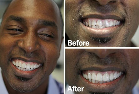 porcelin veneers before after porcelin veneers before after