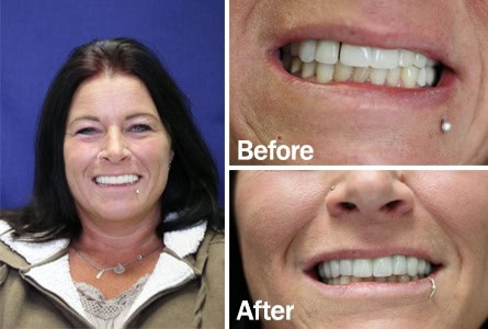 smile makeover before after smile makeover before after