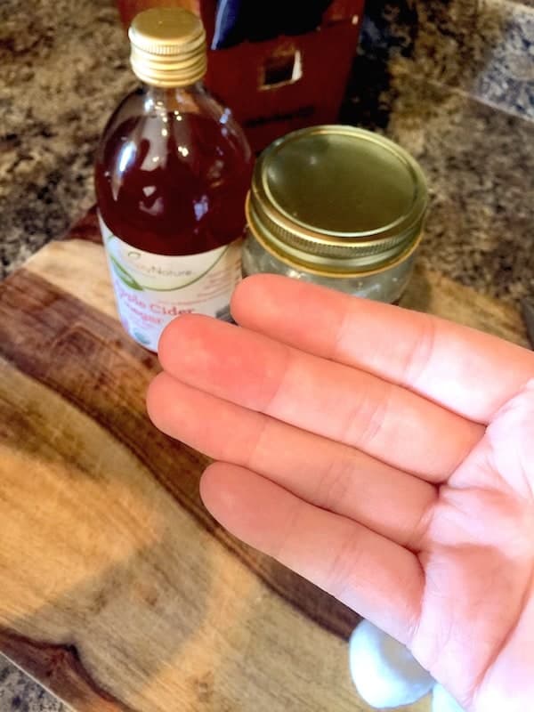 A photo of a hand help palm up to the camera to show that the wart is gone. Apple cider vinegar and coconut oil in the background.
