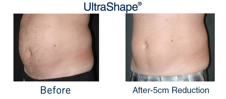 efectividad del ultrashape power