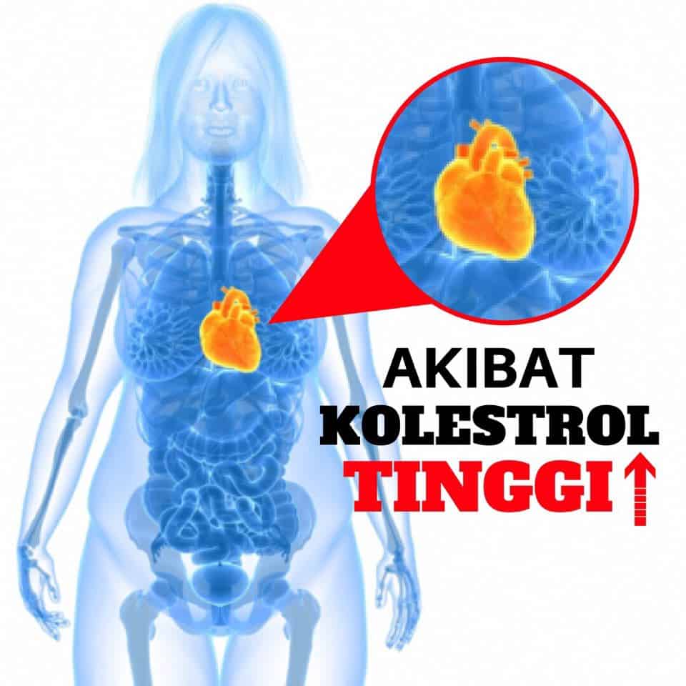AKIBAT KOLESTEROL TINGGI DAN CARA MENJAGANYA AGAR TETAP NORMAL
