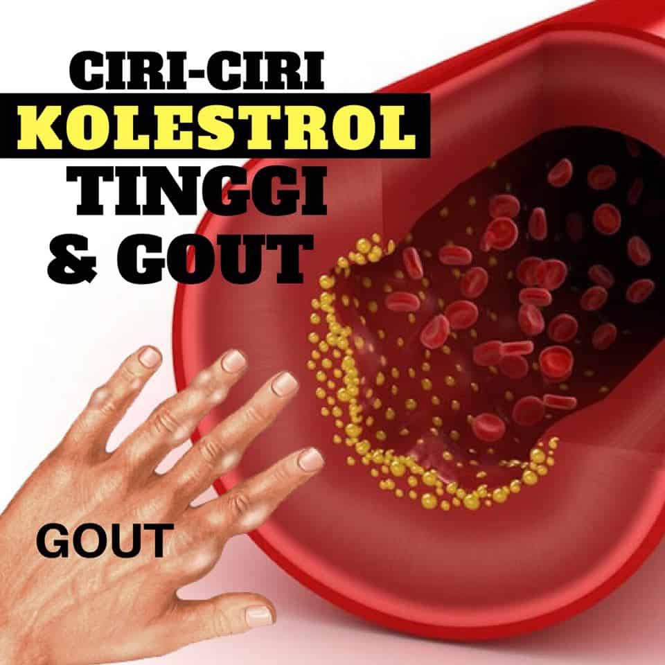 CIRI-CIRI DAN TANDA GEJALA AWAL KOLESTEROL TINGGI