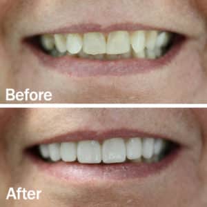VENEERS tony veneers