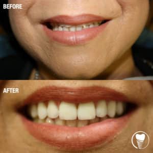 VENEERS veneer case 1b