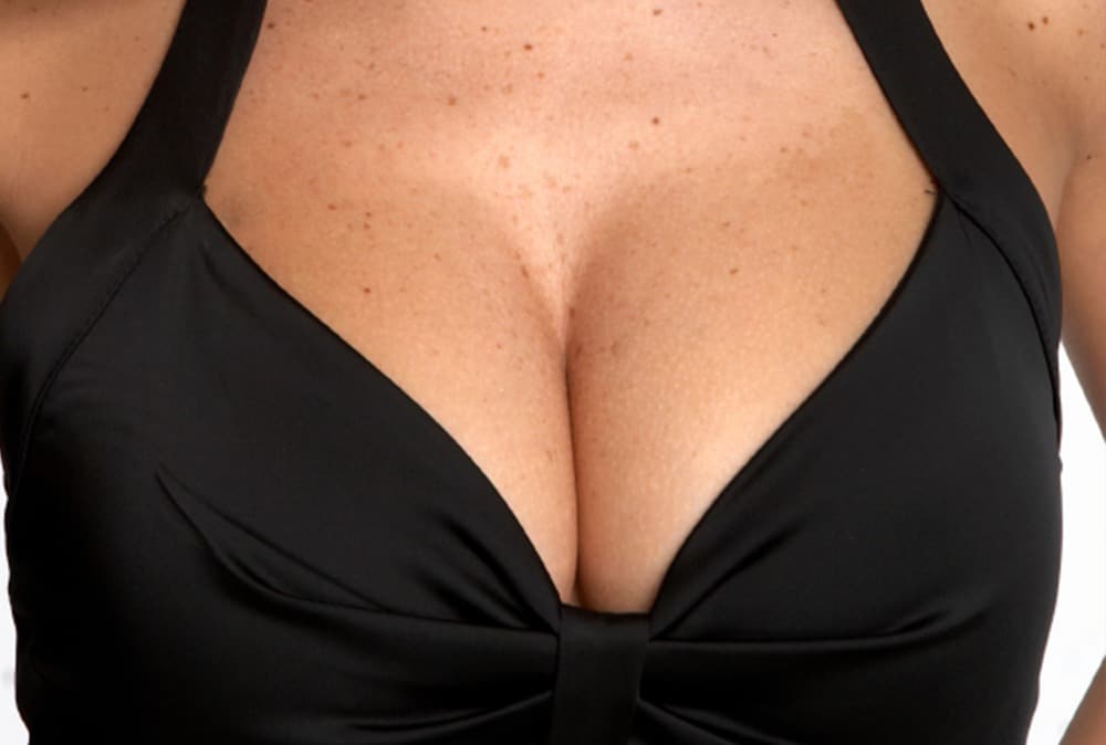 What Are My Breast-Lift Incision Options?