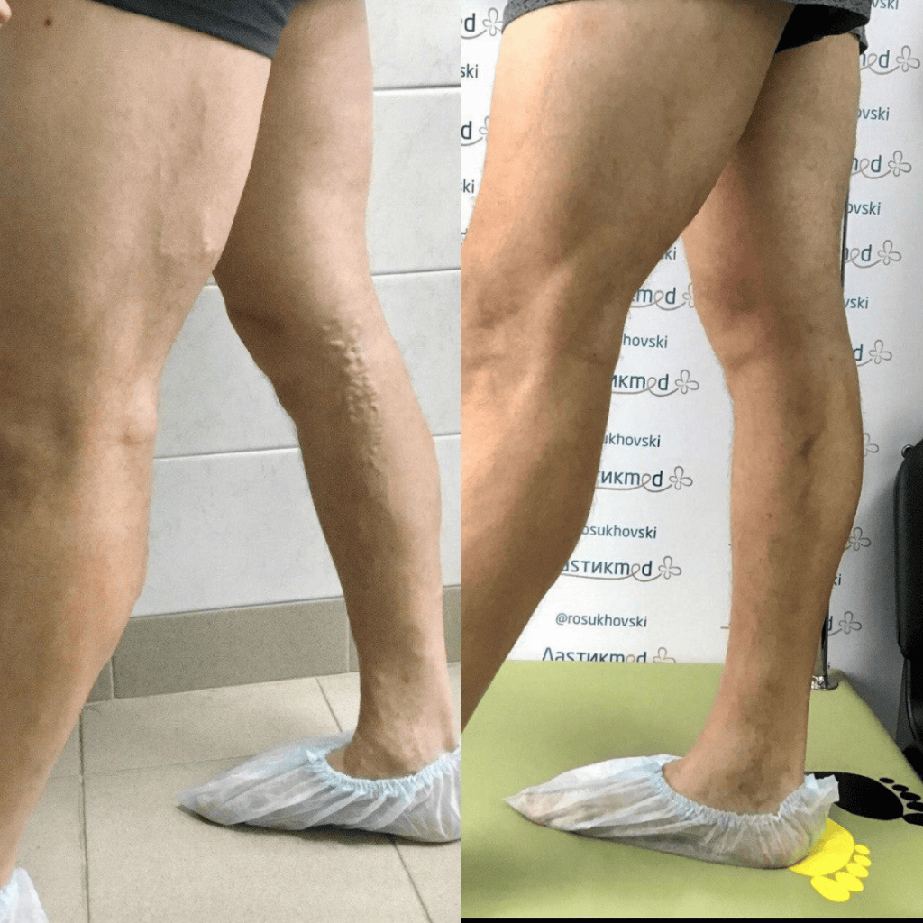 ЭВЛК фото до и после. Лечение варикоза без операции.