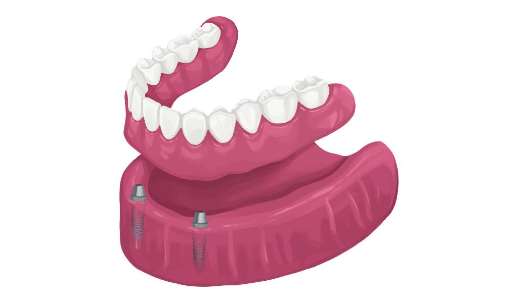 snap Dentures in Houston