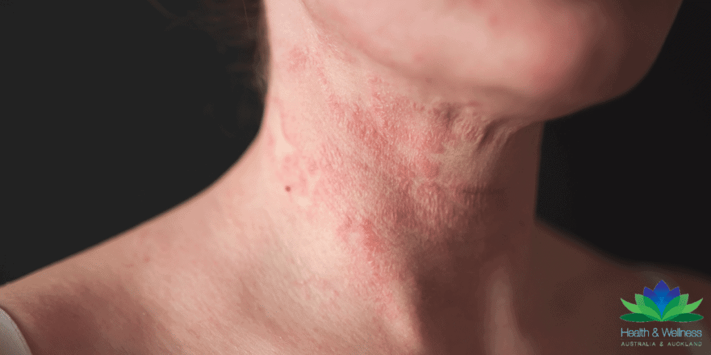 woman with eczema on her neck seeking natural eczema relief
