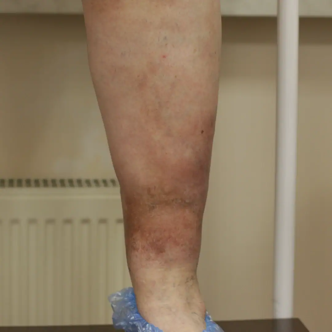 venoznaya-ekzema-lazernoe-lechenie-varikoza