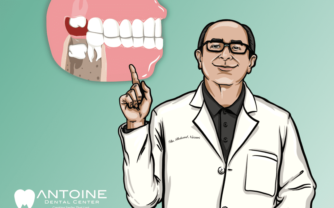 Do I Need My Wisdom Teeth Removed?