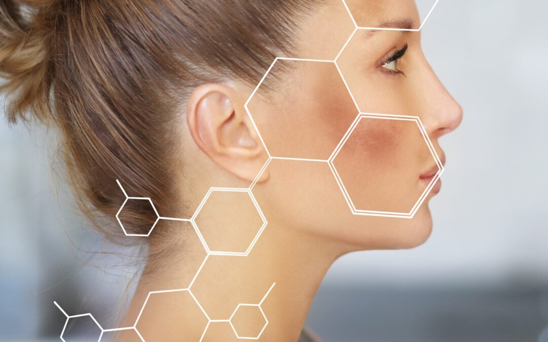 Melasma: cómo tratarlo con exosomas y productos de última generación