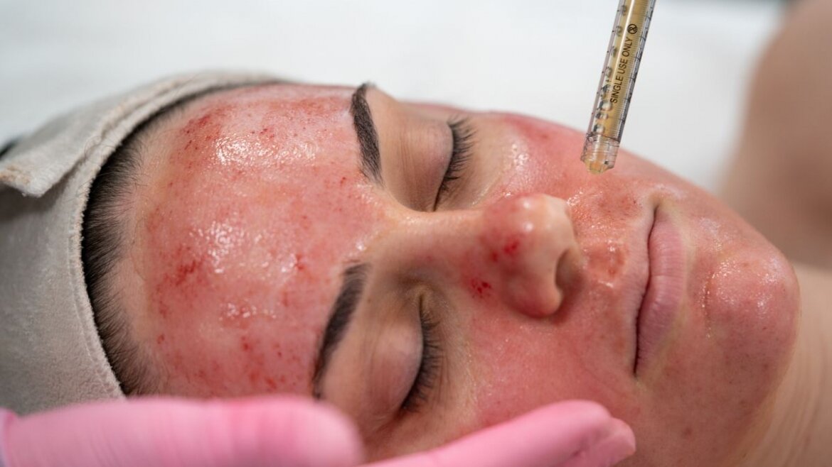 vampire-facelift Vampire facial PRP