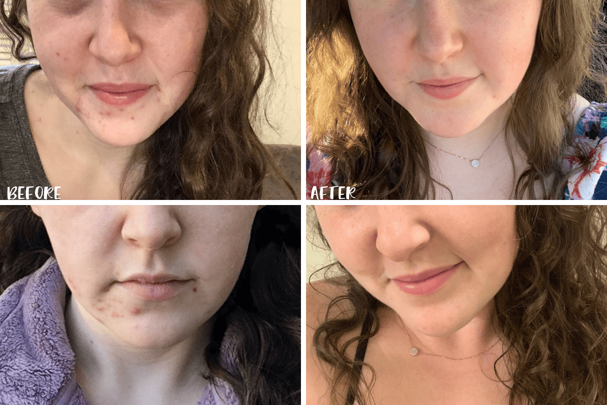 Before and after using products to help clear my skin.