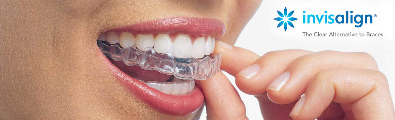 Invisalign Braces - Ladera Ranch