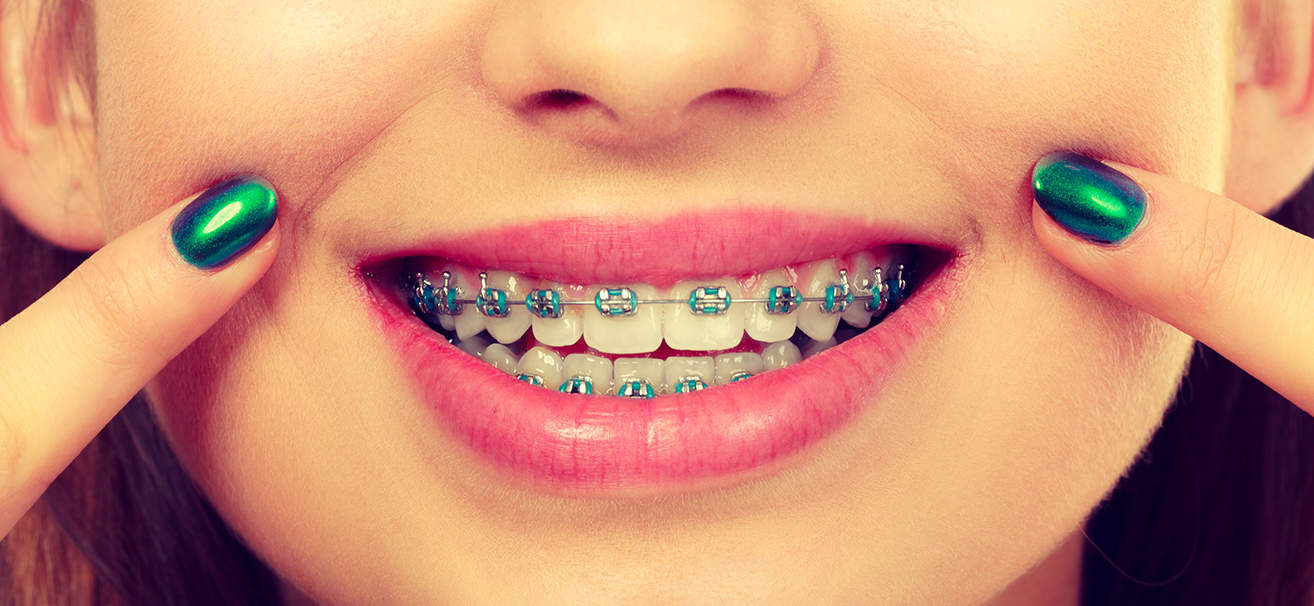 Types of Braces - Orthodontist San Clemente San Juan Capistrano CA