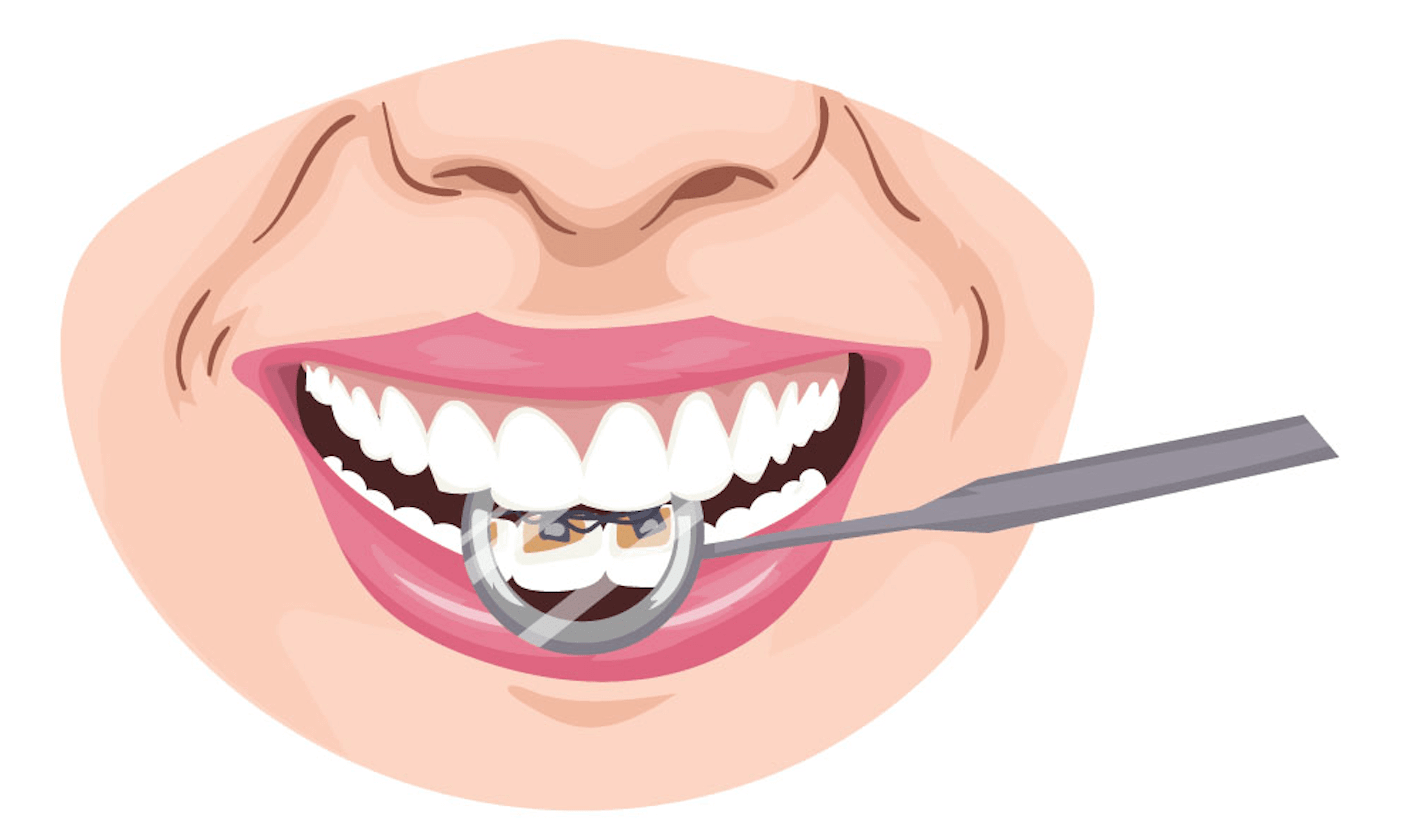 cracked tooth chipped tooth