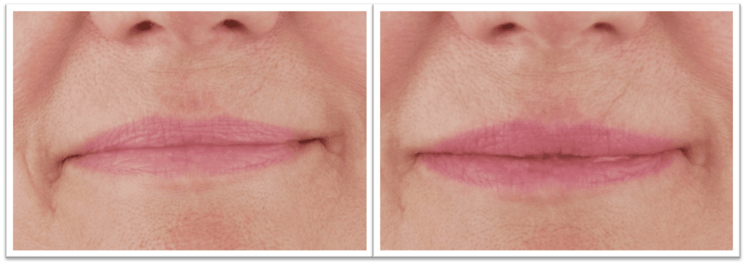 læber før og efter frax