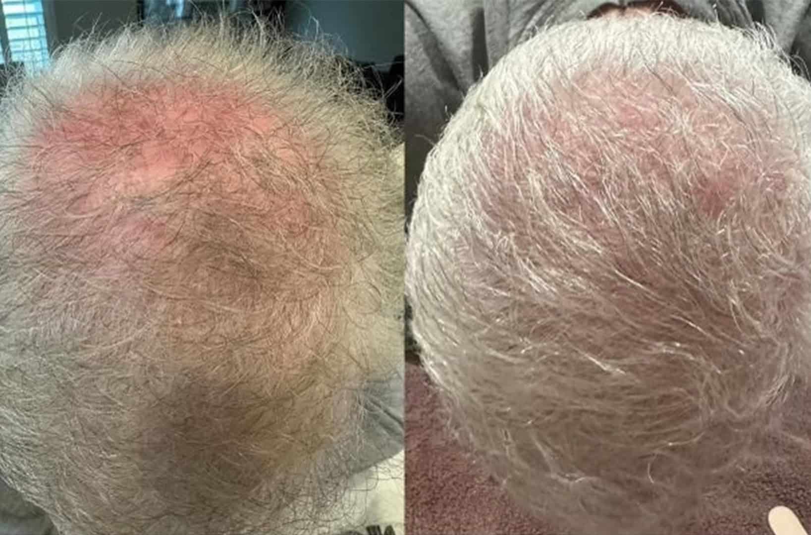 Before and after images of male pattern baldness hair restoration at Gemini Plastic Surgery In Rancho Cucamonga