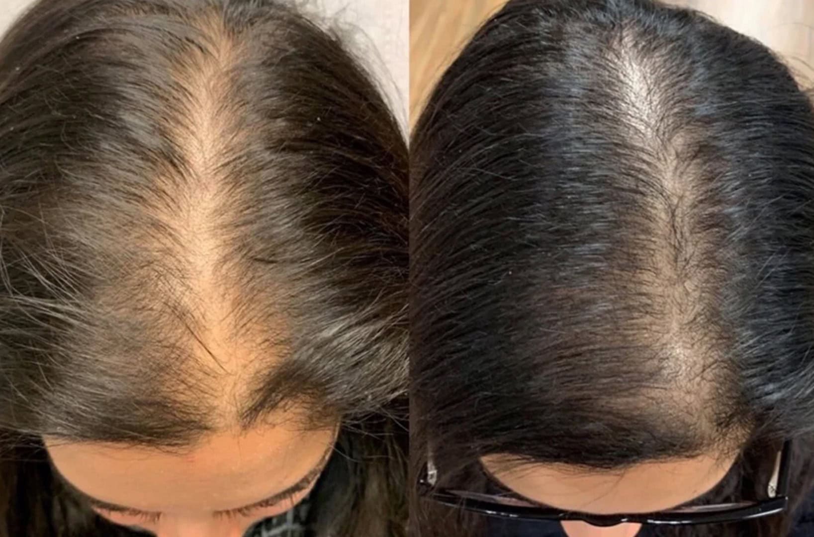 Before and after hair restoration for womens hair thinning hairline regrowth at Gemini Plastic Surgery, Rancho Cucamonga.