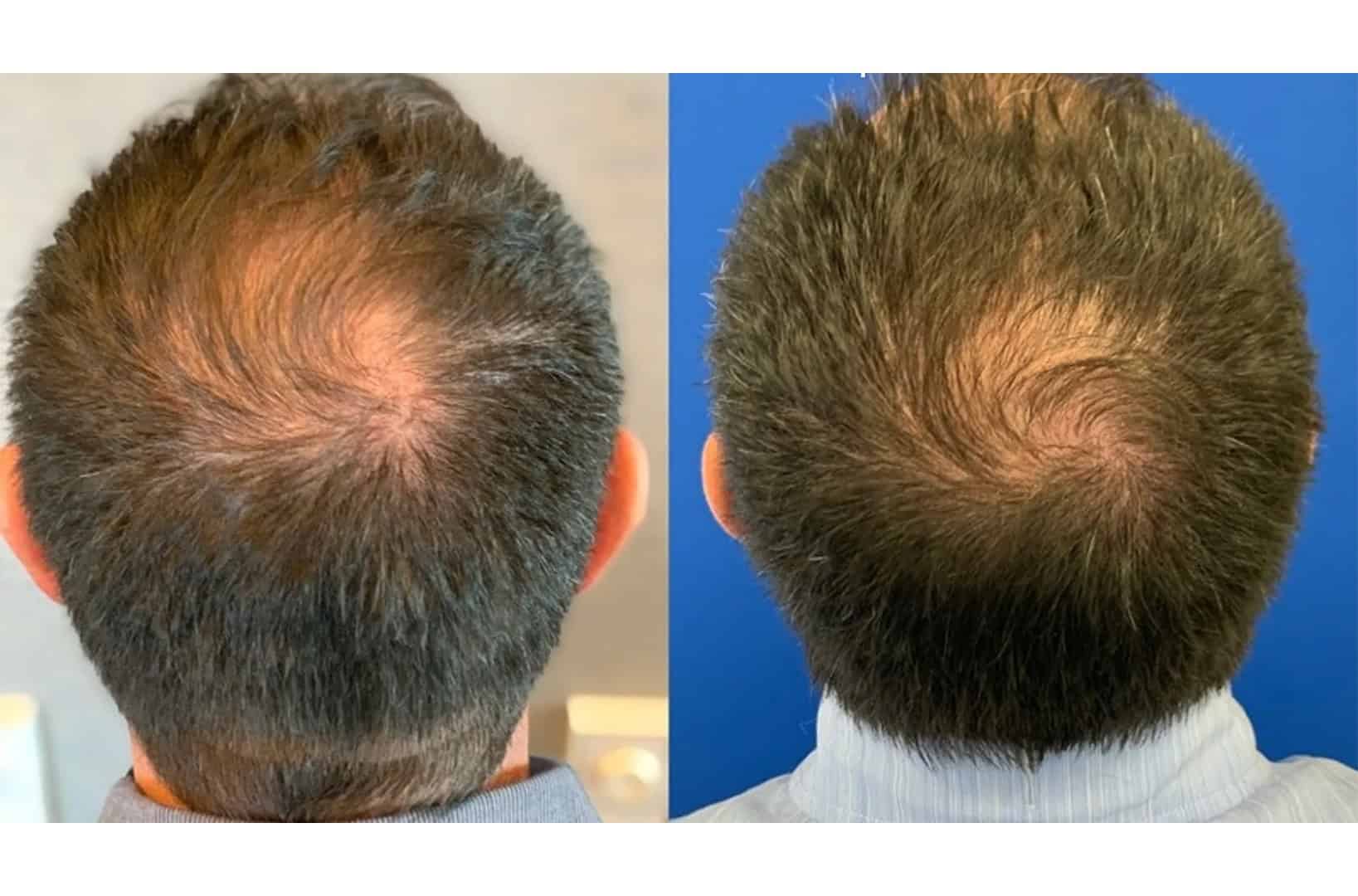 Before and after hair restoration showing full scalp rejuvenation at Gemini Plastic Surgery Inland Empire