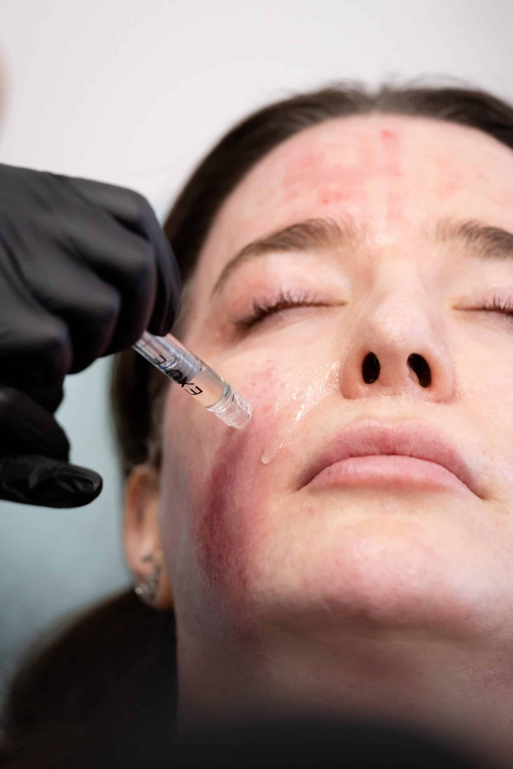 Microneedling EXOIE