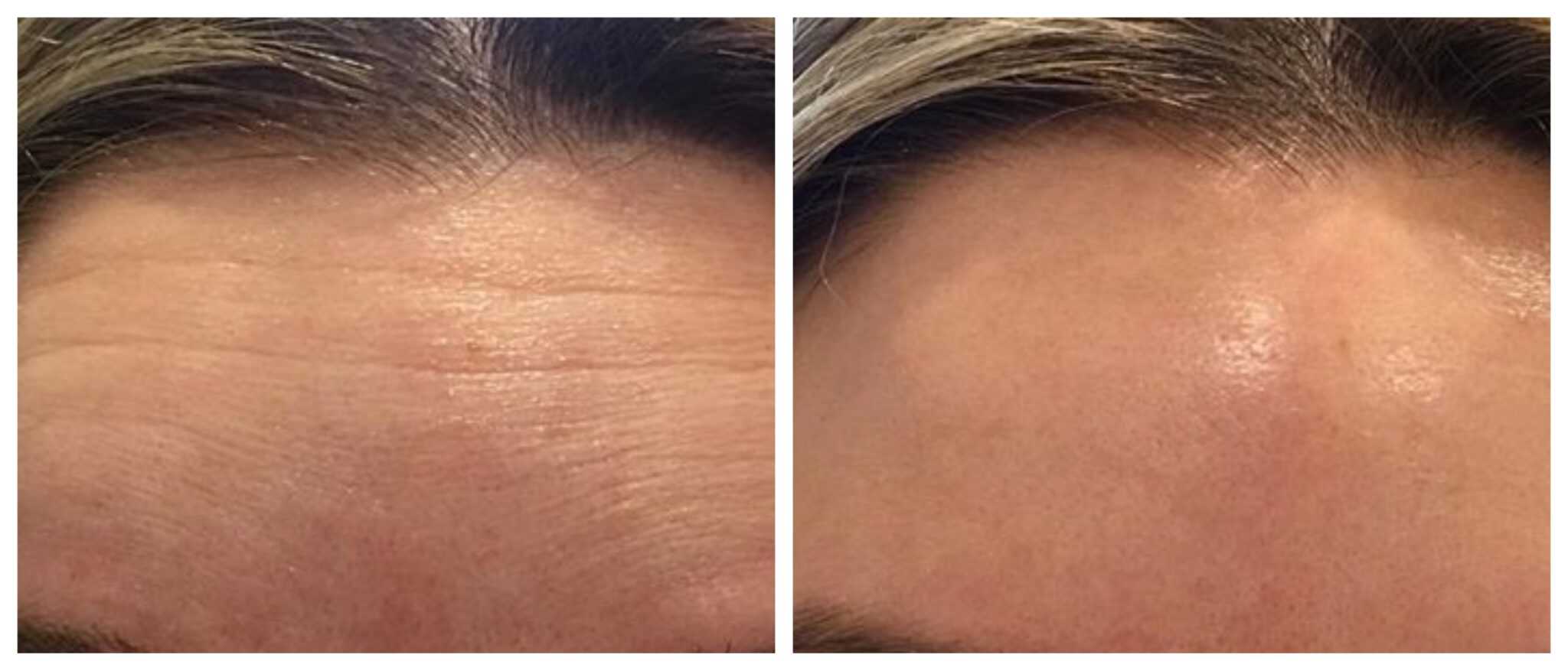 botox mod panderynker