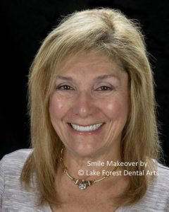 Smile Makeover process
