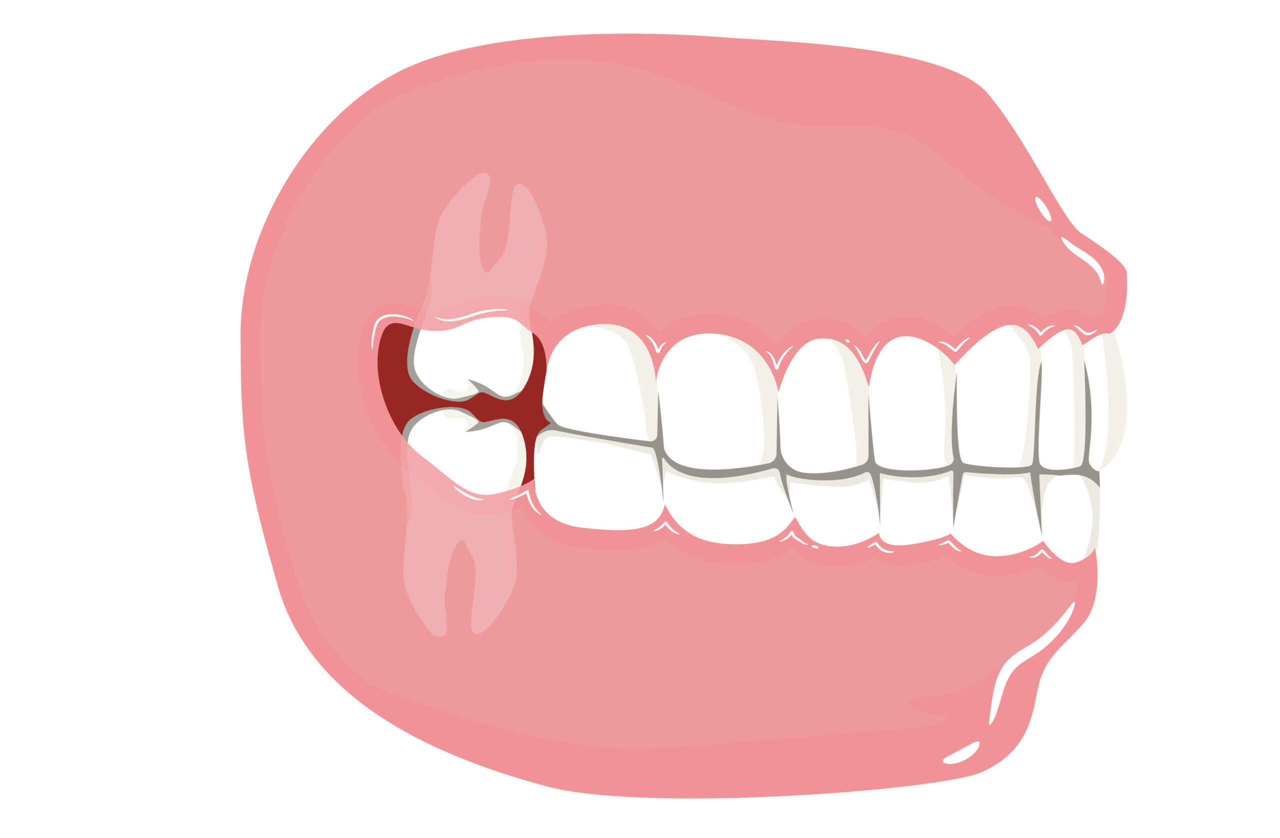 root canal root canal treatment