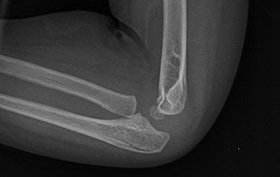 3-year-old boy with a blow to his right elbow 3-year-old boy with a blow to his right elbow