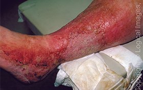 56-year-old woman with swollen, plaque covered leg 56-year-old woman with swollen, plaque covered leg