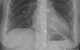 38-year-old with progressive abdominal pain 38-year-old with progressive abdominal pain