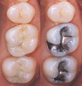plastic fillings