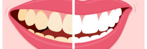 foods that stain teeth