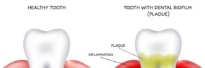 digital illustration of dental plaque