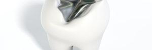 Replace metal fillings