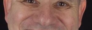 porcelain veneers for men