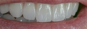 Prepless veneers