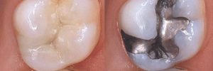 plastic fillings