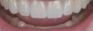 Teeth caps