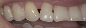 Lost gum from between teeth